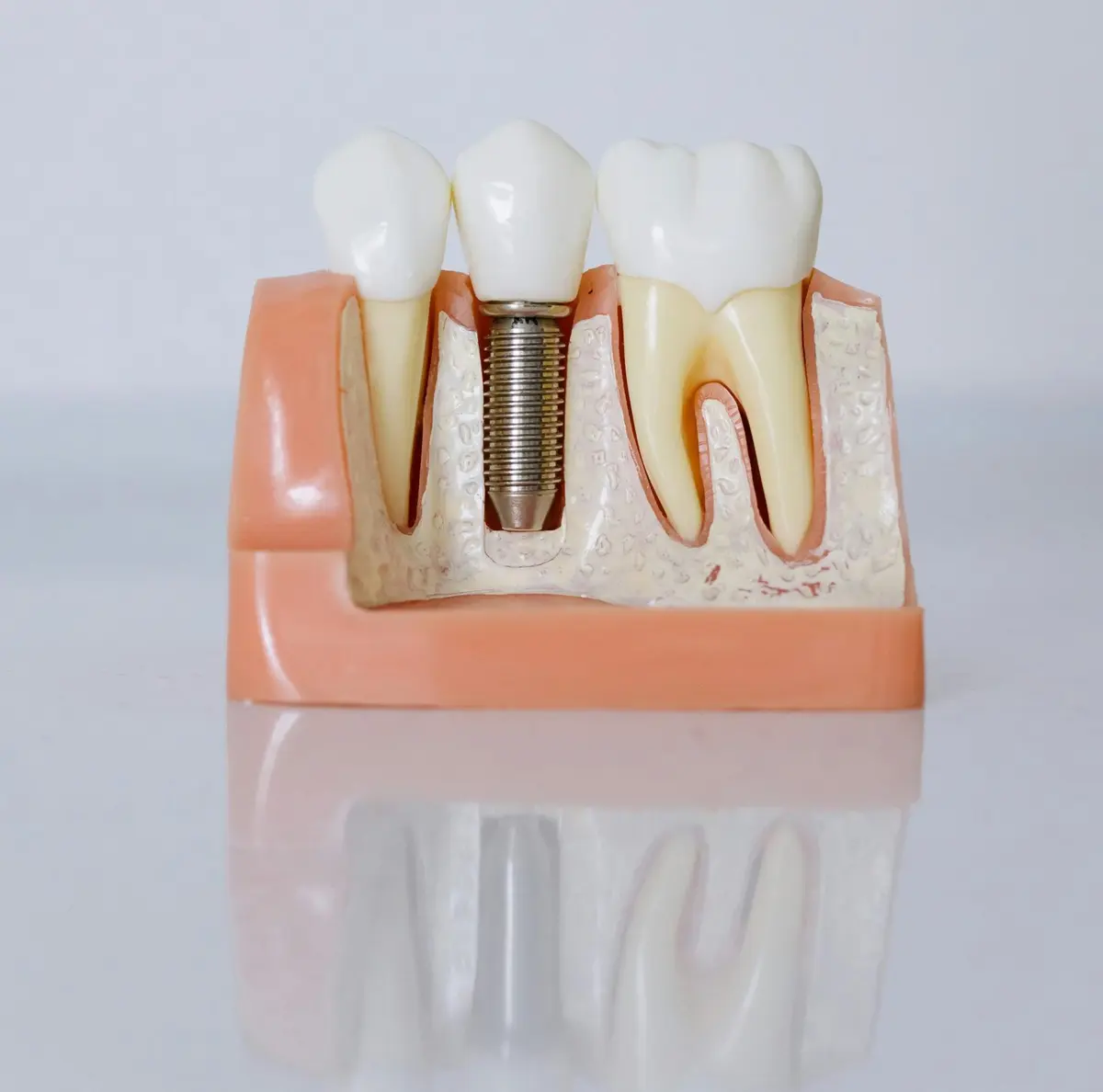 implantes inmediatos postextracción