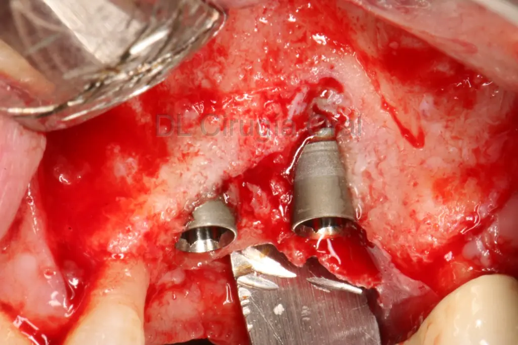 colocación de implantes con falta de hueso