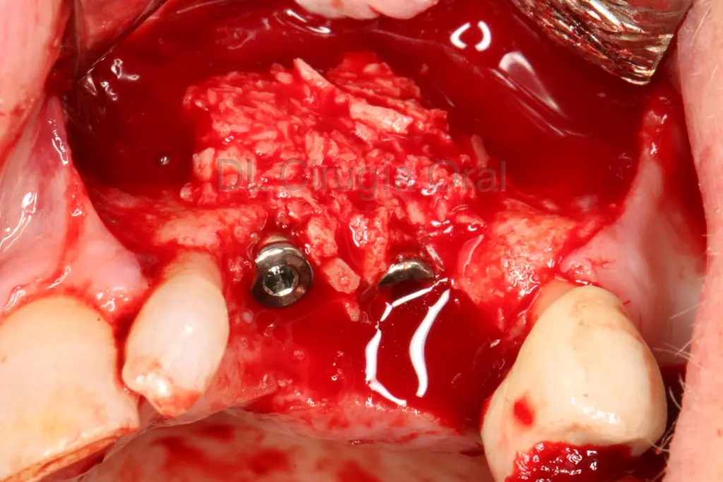 regeneración con hueso autólogo en implantes con falta de hueso