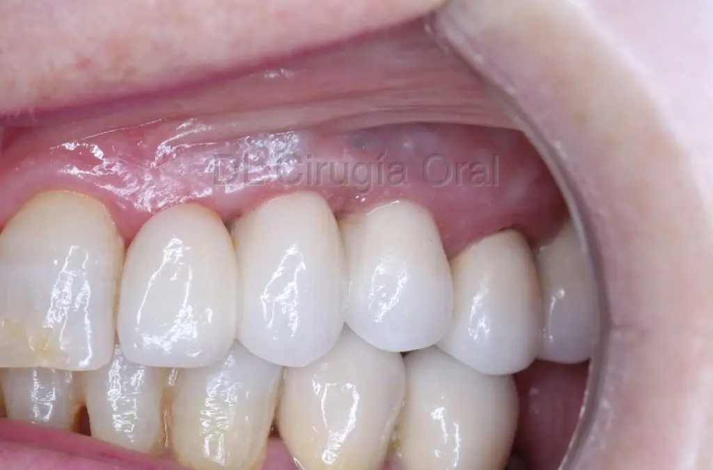 implantes dentales con falta de hueso