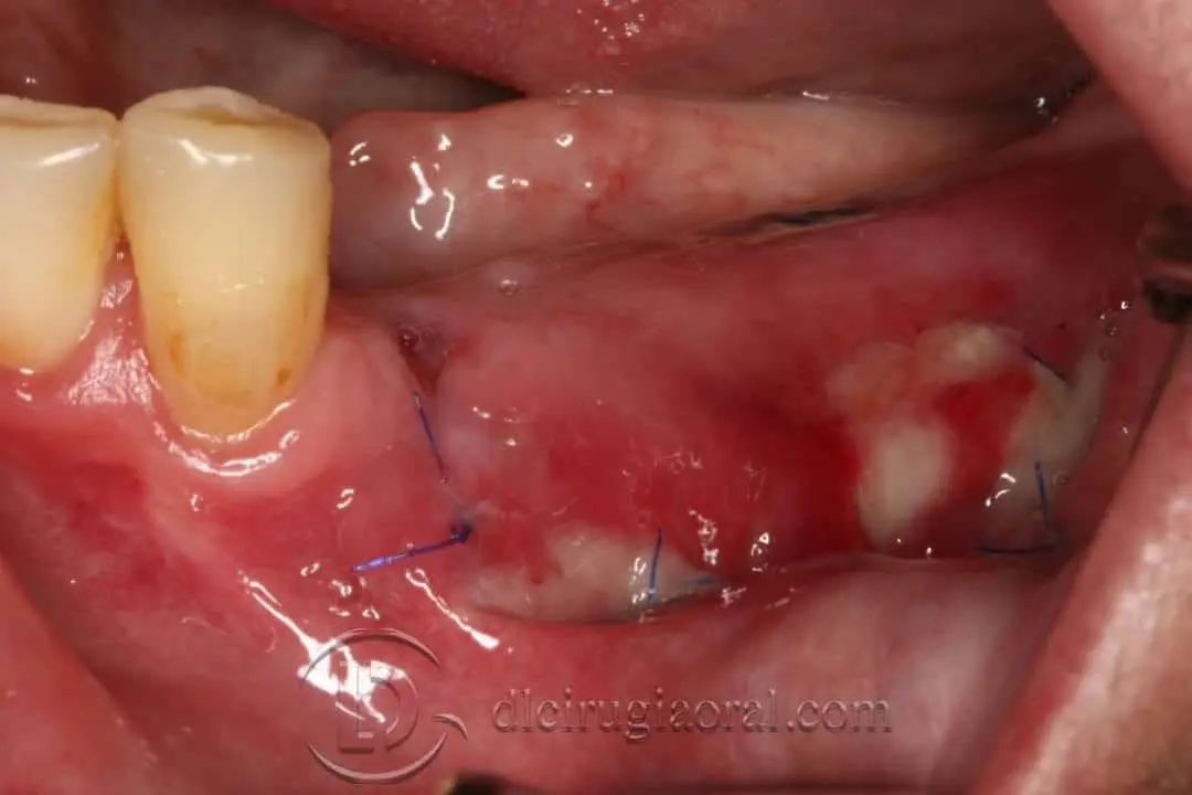 resultado vestibuloplastia de kazanjian